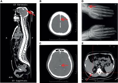 Radiofrequency Ablation of Parathyroid Glands to Treat a Patient With Hypercalcemia Caused by a Novel Inactivating Mutation in CaSR